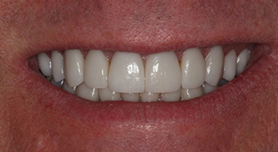 Close-up image of a person’s smile showing bright, evenly shaped, and aligned teeth after cosmetic dental treatment – Kingsport Dentist