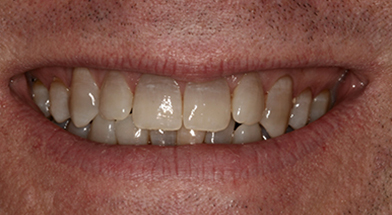 Close-up image of a person’s smile showing discolored and worn teeth with uneven edges prior to cosmetic dental treatment – Kingsport Dentist