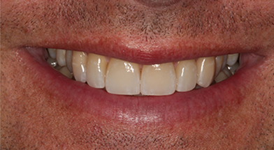 Close-up image of a person’s smile showing natural-looking, evenly aligned teeth with improved color and shape after cosmetic dental treatment – Kingsport Dentist