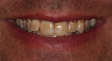 Close-up image of a person’s smile showing severe discoloration, uneven alignment, and worn edges of teeth prior to cosmetic dental treatment – Kingsport Dentist
