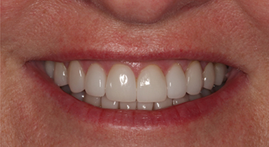 Close-up image of a person’s smile showing bright, gap-free, and evenly aligned teeth after cosmetic dental treatment – Kingsport Dentist