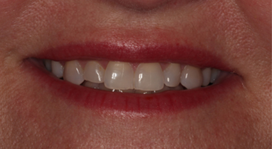 Close-up image of a person’s smile showing visible gaps and uneven alignment of teeth prior to cosmetic dental treatment – Kingsport Dentist