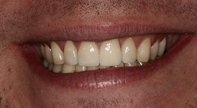 Close-up image of a person’s smile showing healthy, evenly aligned teeth with improved color and shape after cosmetic dental treatment – Kingsport Dentist