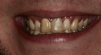 Close-up image of a person’s smile showing severe discoloration, gaps, and misaligned teeth prior to cosmetic dental treatment – Kingsport Dentist