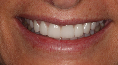 Close-up image of a person’s smile showing bright, symmetrical, and evenly aligned teeth following cosmetic dental treatment – Kingsport Dentist