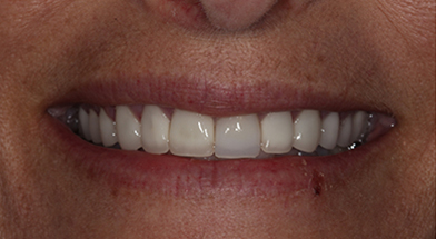 Close-up image of a person’s smile showing restored, evenly aligned teeth with a bright and natural appearance after cosmetic dental treatment – Kingsport Dentist
