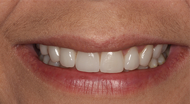 Close-up image of a person’s smile showing bright, healthy-looking teeth with even alignment and no visible decay after cosmetic dental treatment – Kingsport Dentist