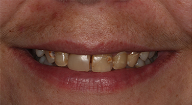 Close-up image of a person’s smile showing tooth decay, discoloration, and uneven edges prior to cosmetic dental treatment – Kingsport Dentist