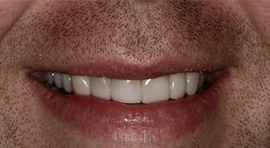 Close-up image of a person’s smile showing smooth, evenly aligned teeth with a bright and natural look after cosmetic dental treatment – Kingsport Dentist