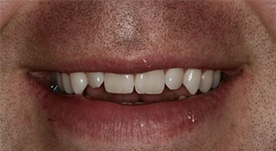 Close-up image of a person’s smile showing uneven alignment and chipped front teeth prior to cosmetic dental treatment – Kingsport Dentist